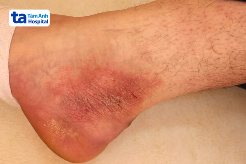 triệu chứng viêm da thần kinh