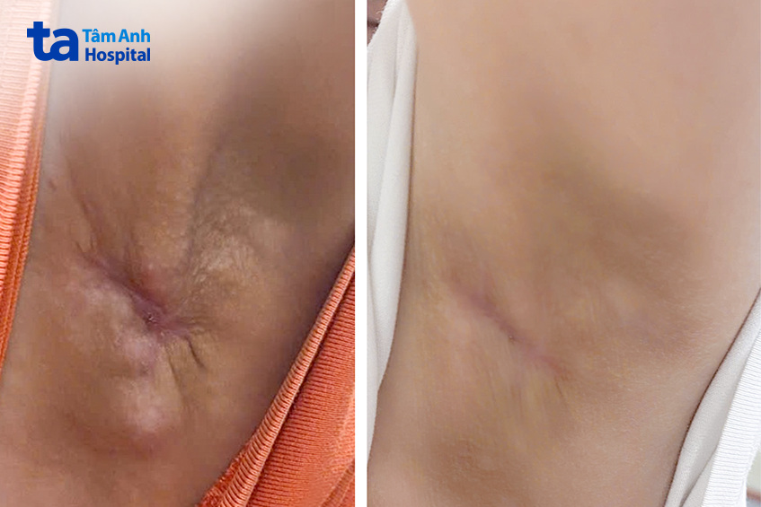 trước và sau điều trị