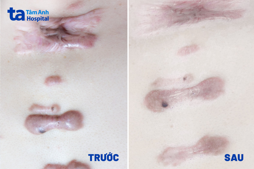 trước và sau khi tiêm điều trị