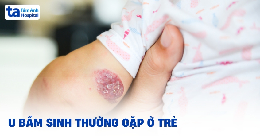 Các loại khối u bẩm sinh thường gặp ở trẻ em