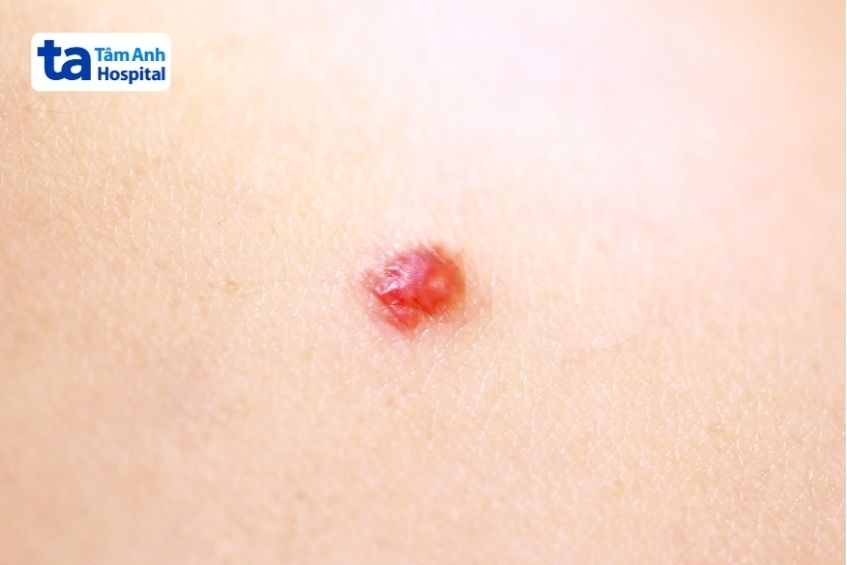 u máu anh đào là tình trạng tăng sinh mạch máu