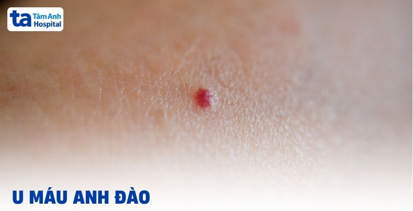 U máu anh đào: Nhỏ nhưng không nên chủ quan