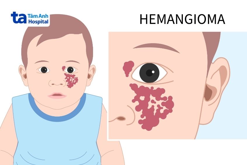 u máu dâu tây trên mặt