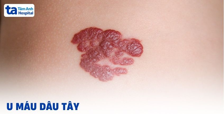 U máu dâu tây là gì? Giải pháp điều trị