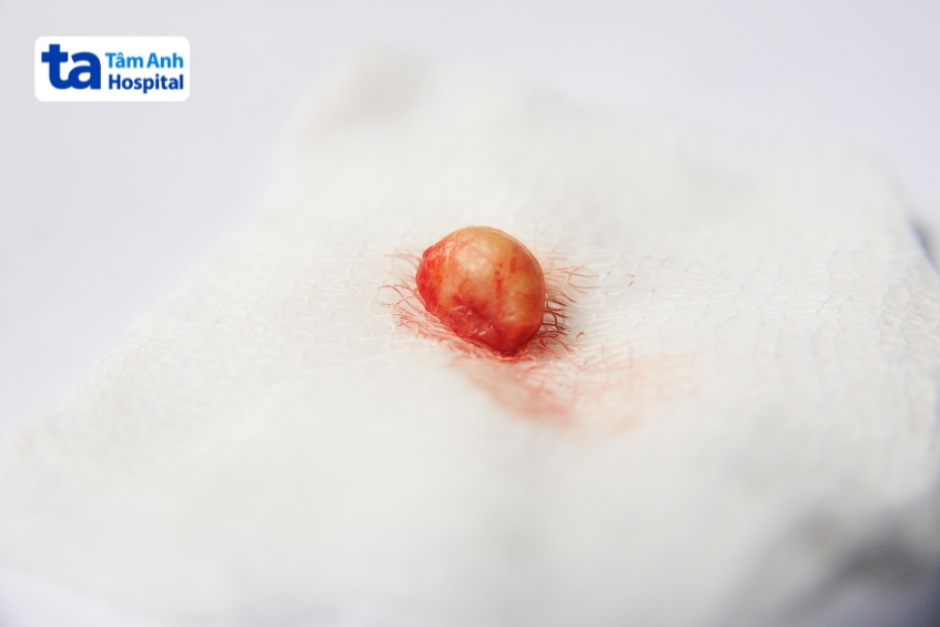 u mỡ được hình thành từ các tế bào mỡ