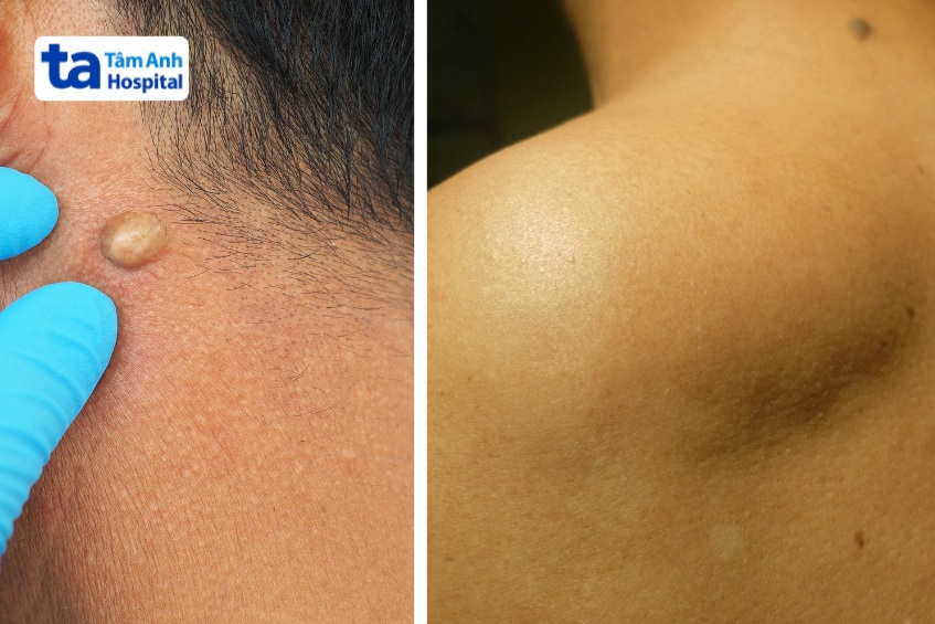 u mỡ gây mất thẩm mỹ hoặc có kích thước lớn