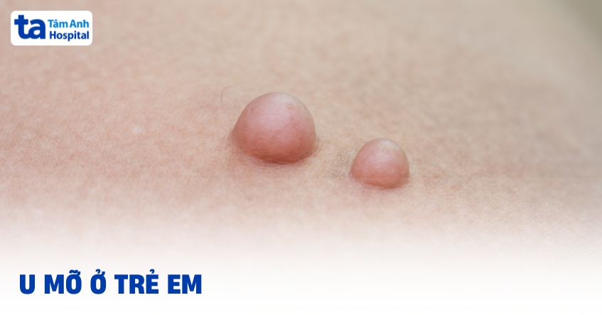 U mỡ ở trẻ em có ảnh hưởng đến sức khỏe không?