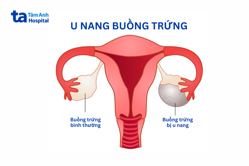 u nang buồng trứng ở trẻ em có thể do nhiều nguyên nhân