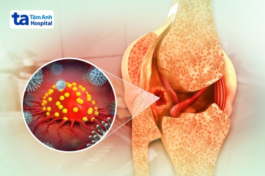 ung thư di căn đến xương