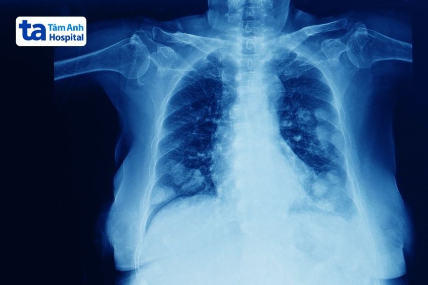 ung thư di căn ở hai phổi