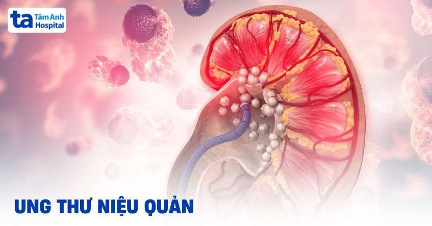Ung thư niệu quản: Giải pháp điều trị như thế nào?