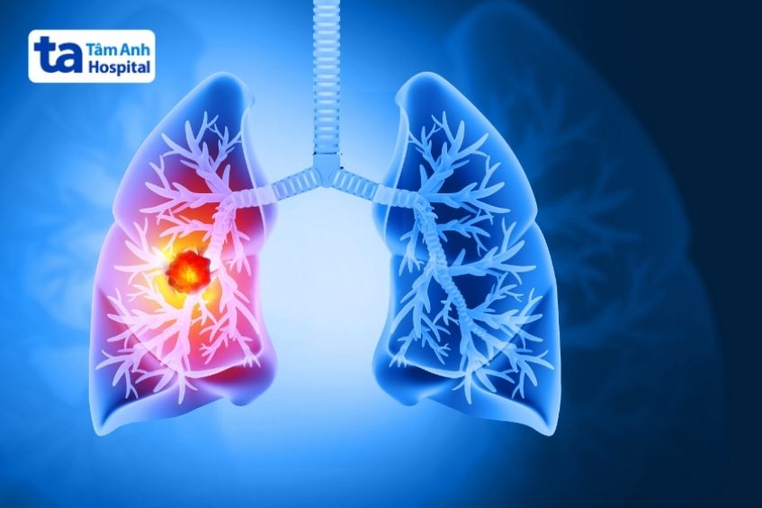 ung thư phổi là một loại ung thư ở nam giới