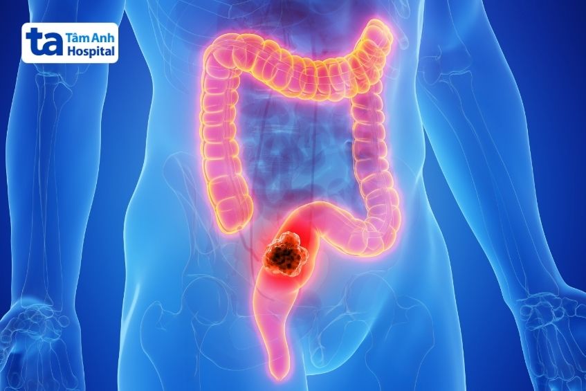 ung thư trực tràng đe dọa tính mạng