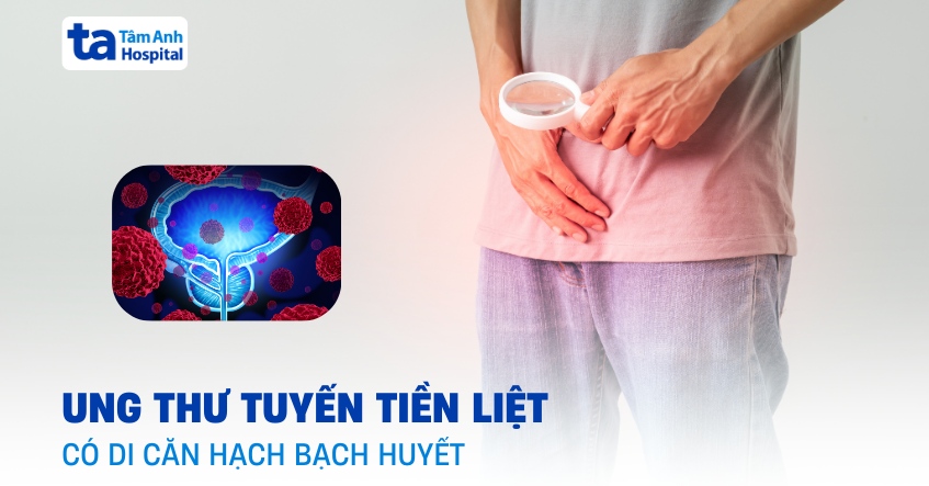 Khả năng ung thư tiền liệt tuyến di căn hạch có cao không?