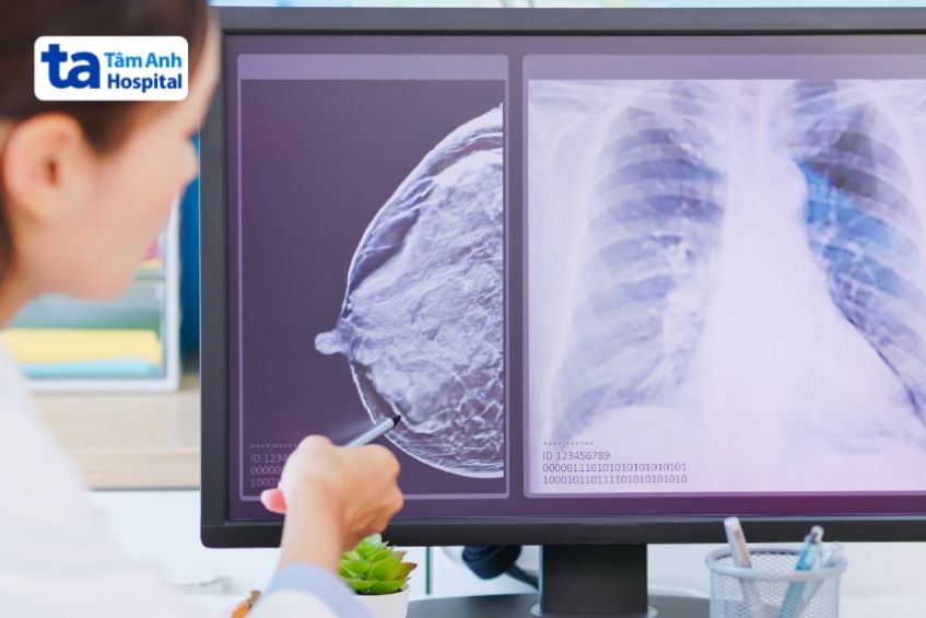 ung thư vú ở nữ giới