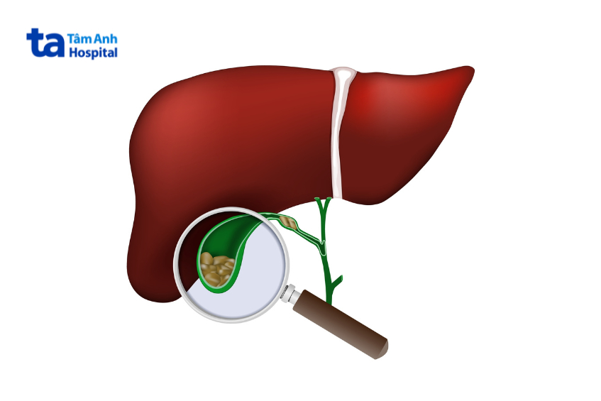 Minh họa gan, túi mật và sỏi mật, liên quan cơ chế tác dụng của ursodeoxycholic acid trong tan sỏi