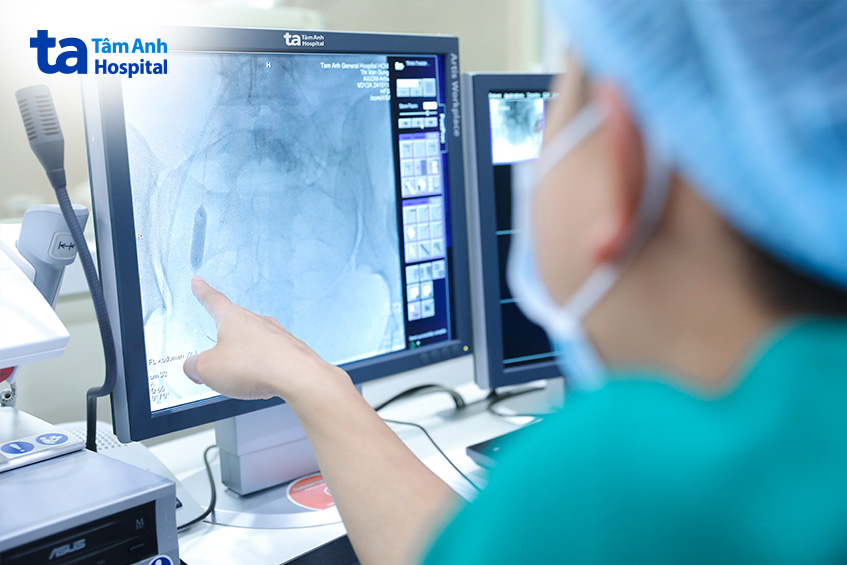 vị trí bóng chèn đặt tại động mạch chậu trong hai bên