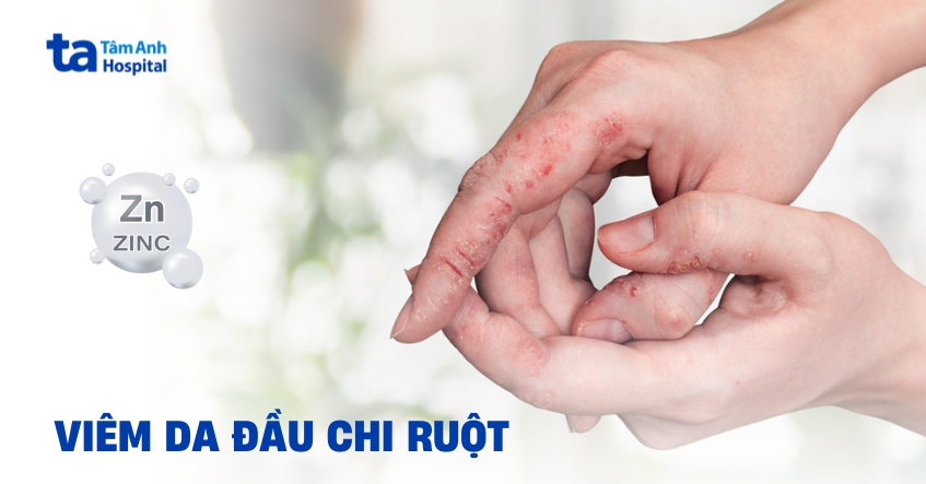 Viêm da đầu chi ruột (Acrodermatitis Enteropathica)
