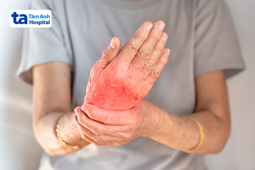 Viêm khớp tự miễn xảy ra ở tay