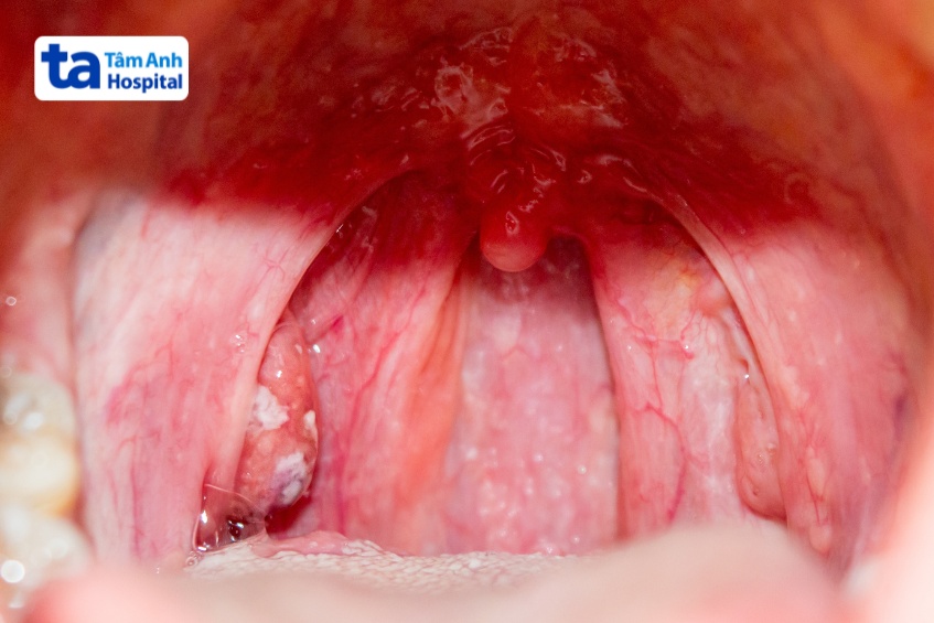 viêm ở hai mô hình bầu dục