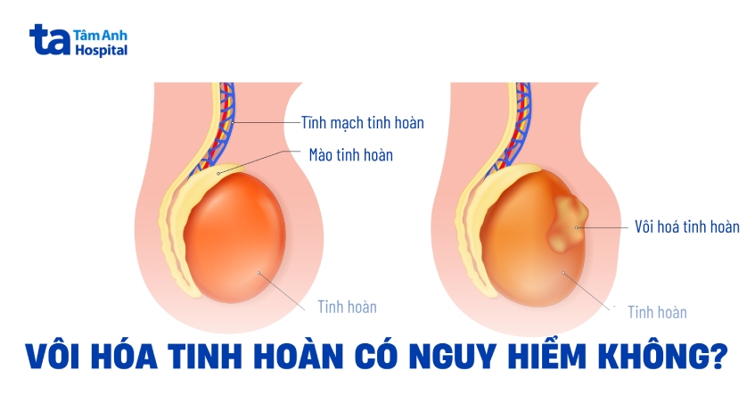 Vôi hóa tinh hoàn có nguy hiểm không? Chữa trị thế nào?