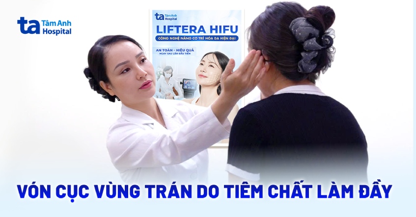 Vón cục vùng trán do tiêm chất làm đầy không rõ nguồn gốc