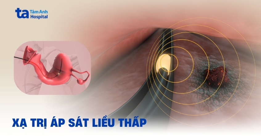 Tìm hiểu thông tin về xạ trị áp sát liều thấp
