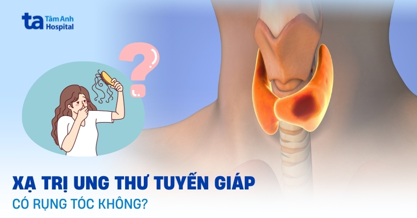 Khi tiến hành xạ trị tuyến giáp có rụng tóc không?