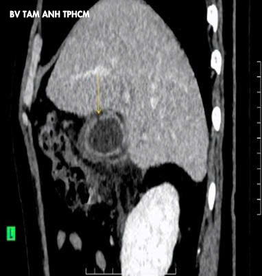 ảnh CT cho thấy túi mật bị hoại tử