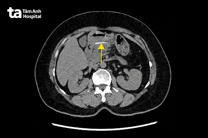 ảnh CT cho thấy xương cá