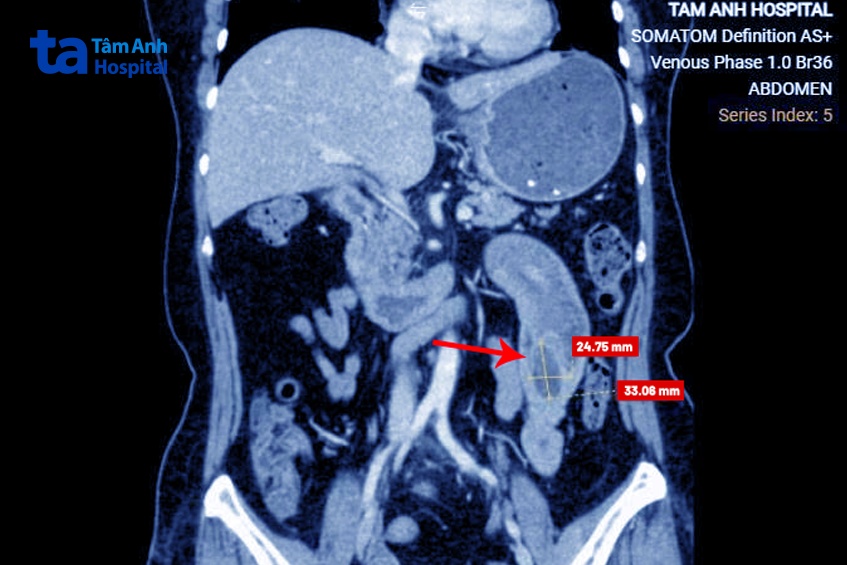 ảnh ct khối u gây lồng ruột