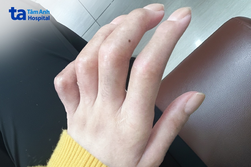 bàn tay chị tú sưng, căng cứng khớp không thể cầm nắm, co duỗi do bệnh