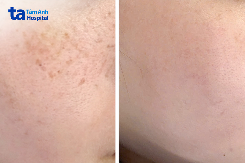 các mảng nám và tàn nhang của chị Hường sau điều trị