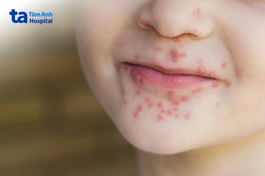 các nốt đỏ hoặc mụn nước xuất hiện quanh miệng là dấu hiệu điển hình của tay chân miệng ở trẻ em