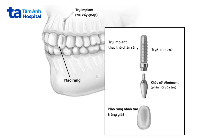 Mô hình cấu tạo trồng răng implant gồm trụ titanium, khớp nối abutment và mão răng sứ thay thế chân răng đã mất