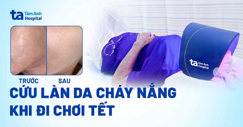 Cứu làn da cháy nắng khi đi chơi Tết