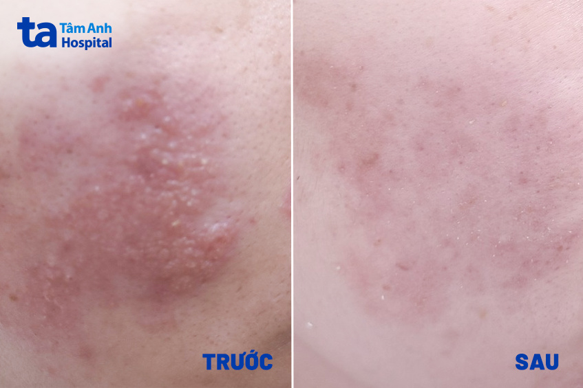 da đỏ giảm hẳn sau điều trị