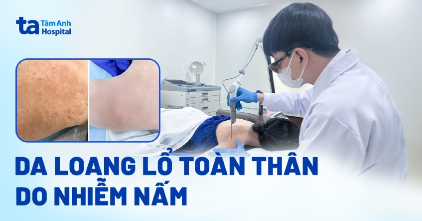 Da loang lổ toàn thân do nhiễm nấm