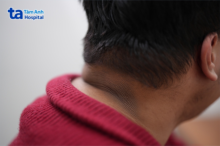 dấu hiệu gai đen vùng cổ đặc trưng ở người bệnh đái tháo đường