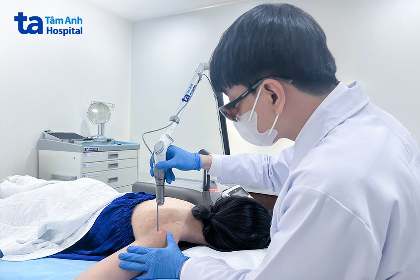 điều trị da loang lỗ bằng laser