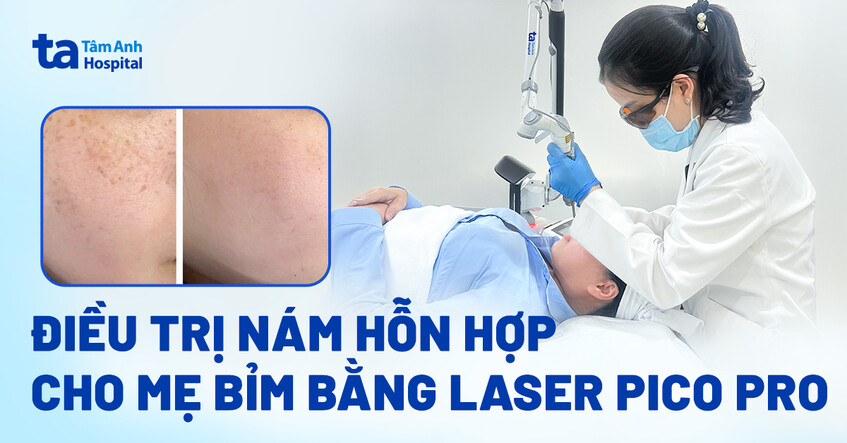 Điều trị nám hỗn hợp cho mẹ bỉm bằng laser Pico Pro