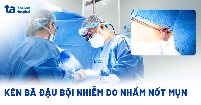 Kén bã đậu bội nhiễm do nhầm nốt mụn
