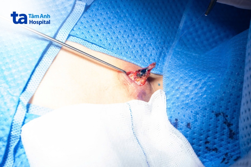 kén bã đậu vùng ngực của Liên khoảng 2 cm, bội nhiễm.