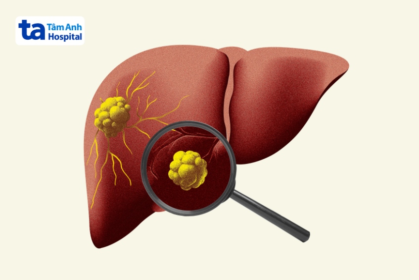 khối u gan ác tính