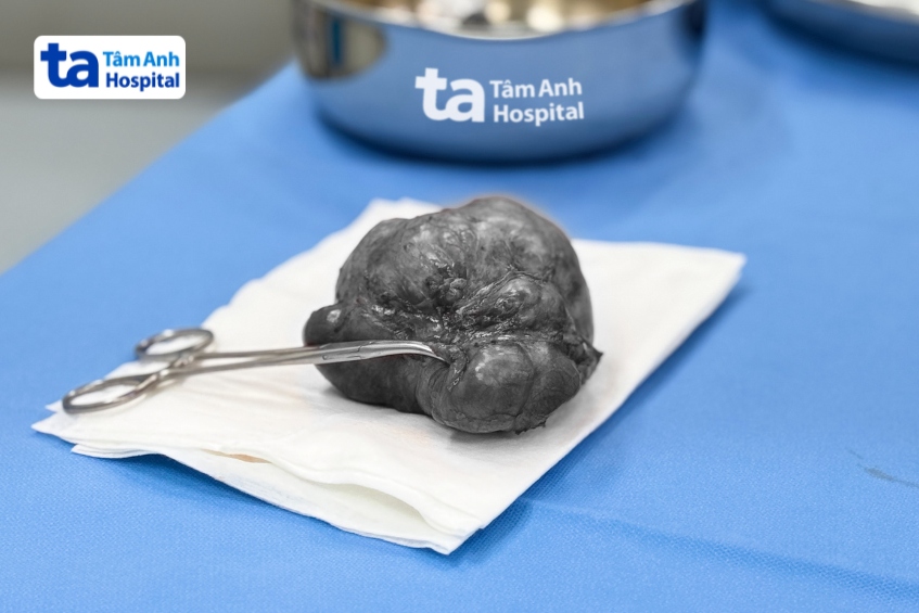 khối u quái vùng cùng cụt được bóc tách hoàn toàn