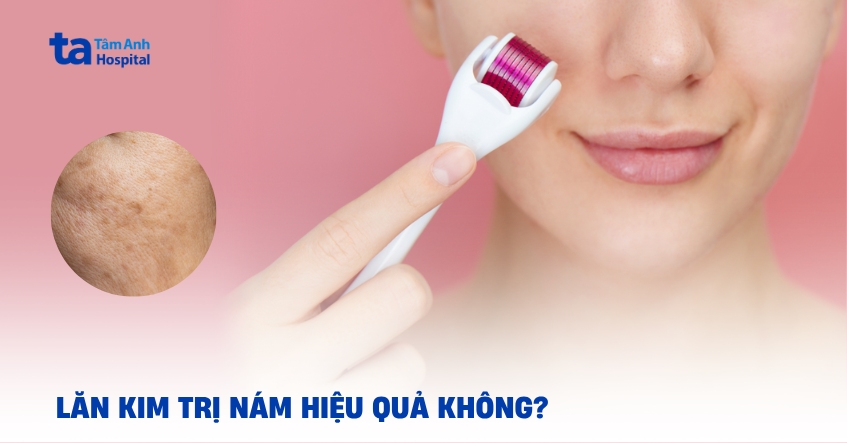 Lăn kim trị nám: Chỉ định và chống chỉ định