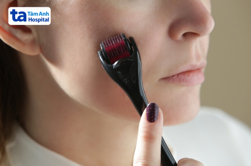 lăn kim trị nám có tốt không