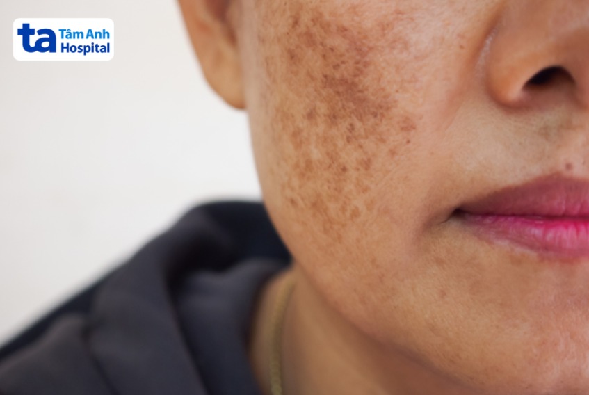 lăn kim trị nám là như thế nào