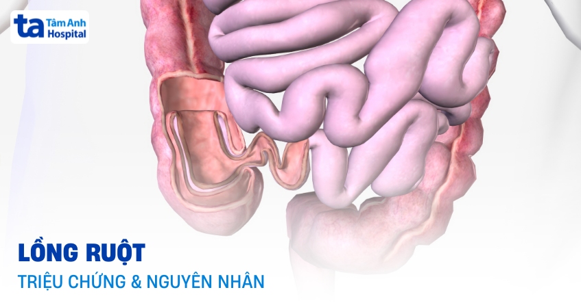 Nhận biết lồng ruột: Ai có nguy cơ mắc phải?