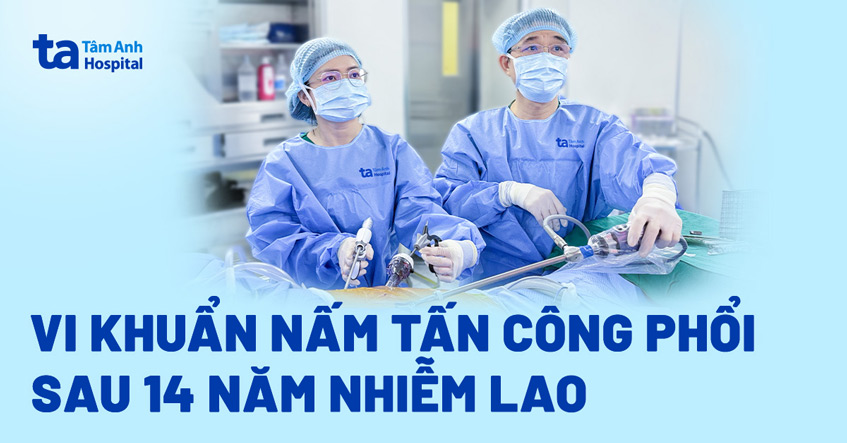 Ổ nấm trong phổi sau 14 năm nhiễm lao